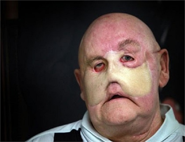 Tưởng chừng đã loại bỏ toàn bộ khối u nhưng 6 tháng sau, ông lại tiếp tục phải điều trị. Ông Martin đã mất tổng cộng 6 tháng nữa để tái tạo lại mũi của mình. 