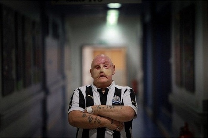 Các chuyên gia đã nói với ông Martin rằng đó là may mắn vì ung thư phát triển bên ngoài cơ thể và được phát hiện kịp thời.