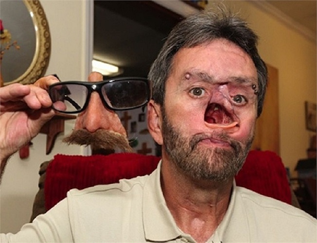 Một trường hợp khác là ông Donnie Fritts (Mỹ) phải khoét đi một phần khuôn mặt bởi căn bệnh ung thư biểu mô ác tính.