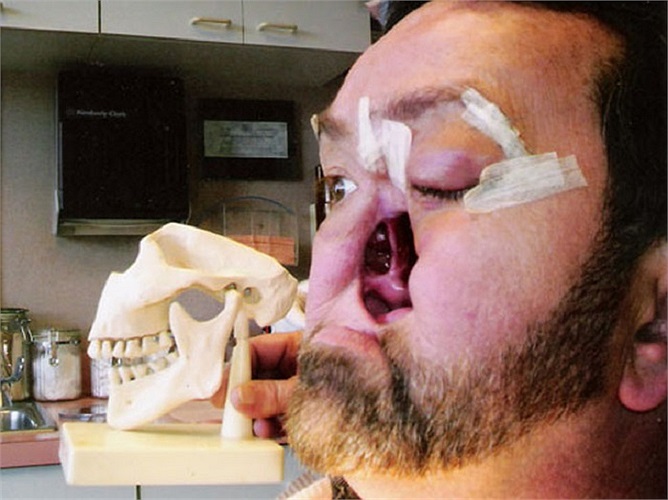 Cận cảnh khuôn mặt nhìn nghiêng sau ca phẫu thuật cắt bỏ.