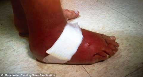 Vi khuẩn ăn thịt làm chết người khủng khiếp