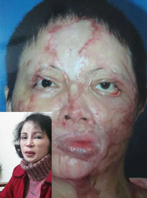 Chị Loan trước và sau 41 ca phẫu thuật thẩm mỹ