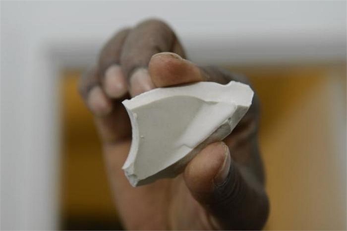 Hậu quả khiến ông Pierre phải khâu đến 30 mũi ở các vùng như đầu, tay và chân sau khi bị các mảnh vỡ bồn cầu bắn vào người.