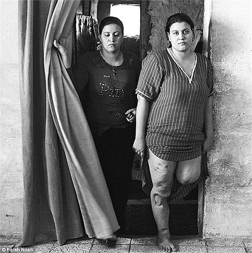 Năm 2008, một cuộc không kích của Mỹ vào thành phố Sadr đã khiến Rena (phải) sảy thai và mất đi chân trái.