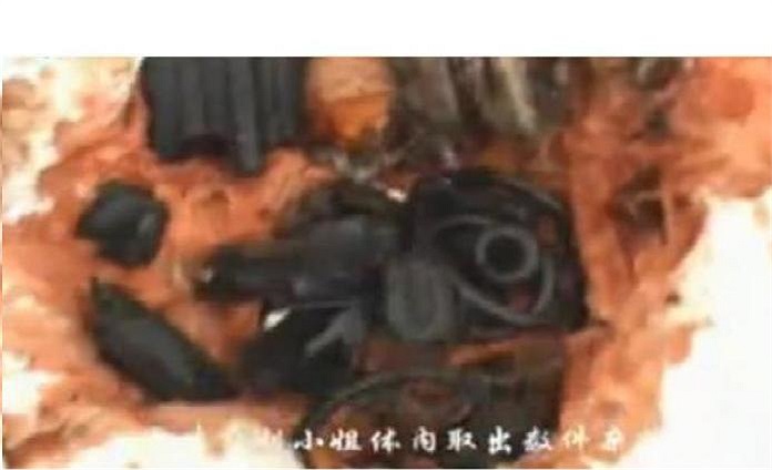 Tại bệnh viện, các bác sĩ đã nỗ lực gắp bỏ nhiều ốc vít và mảnh nhựa bị vỡ của chiếc ghế (loại ghế dùng khí để nâng lên hạ xuống) ra khỏi người bệnh nhân. 