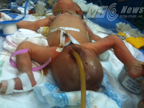 Đà Nẵng, bệnh viện, sản nhi, khối u, trẻ sơ sinh, u quái