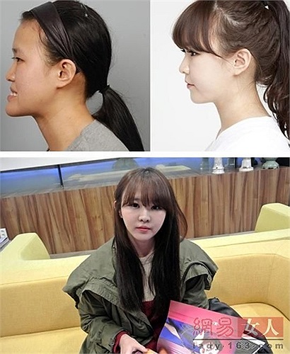 Chiếc cầm nhô ra của cô gái trở nên thon gọn trông thấy sau phẫu thuật