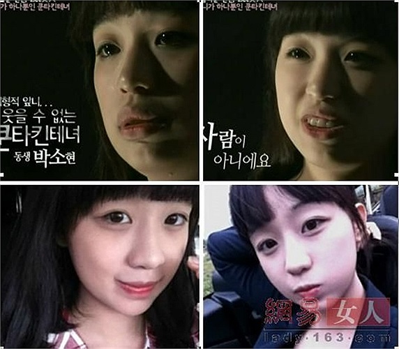 Cô gái có chiếc miệng duyên hơn sau phẫu thuật thẩm mỹ