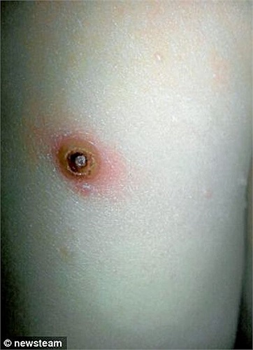 Hình ảnh vết thương của một bé trai 4 tuổi, ngụ tại Shropshire, do loài nhện độc này gây ra. Theo chuyên gia nghiên cứu động vật Owen Leyshon, loài nhện độc False Widow là một trong số ít loài có thể gây ra những vết thương kinh hoàng cho con người.