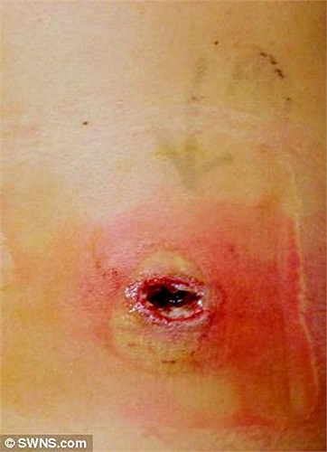 Còn đây là vết đốt tương tự của loài nhện False Widow gây ra. Nạn nhân là cầu thủ bóng đá Steve Harris, vết thương khiến anh vĩnh viễn giã từ sự nghiệp cầu thủ.