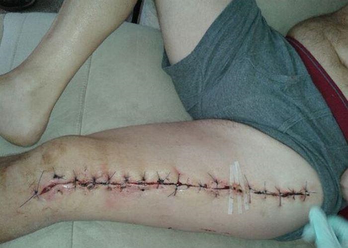 Trước đó, một nạn nhân 39 tuổi, Ricki Whitmore, gần như mất đi chân trái khi bị nhện False Widow cắn trúng. Các bác sĩ buộc phải xẻ chân nạn nhân ra để lấy nọc độc khỏi cơ thể.