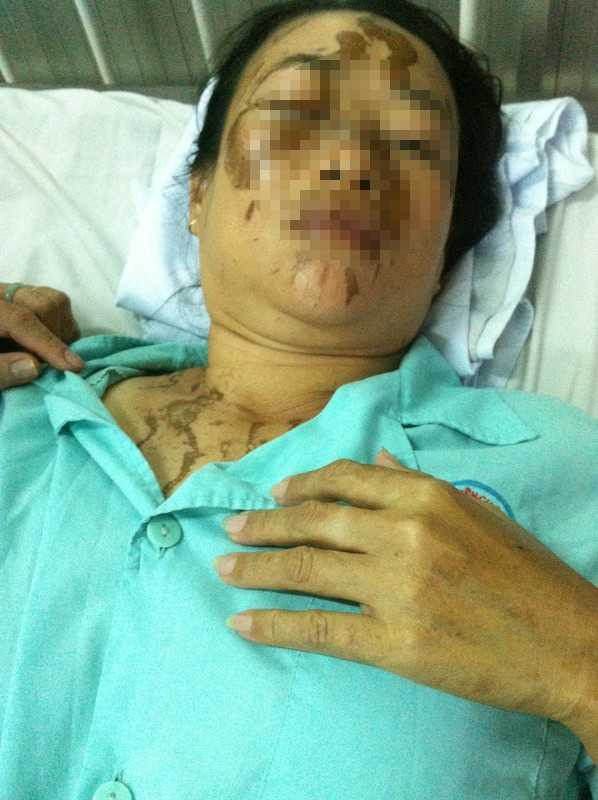 Chị Hà bị a xít văng trúng mắt, mặt và ngực.