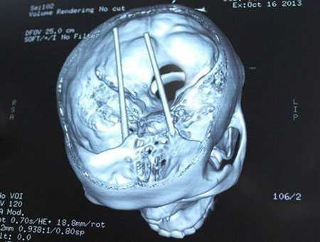  Hai chiếc đũa xuyên qua mắt tới sàn não của anh Dũng. Ảnh: TG