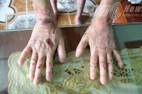 'giời đày', Ly thượng bì bóng nước, Thủy Nguyên, Hải Phòng