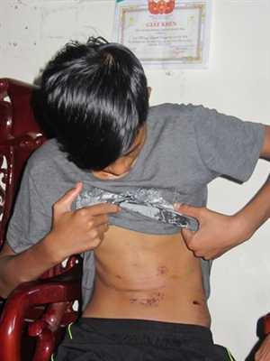 Vết thương còn hằn trên ngực.