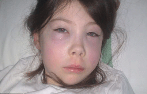 Biểu hiện đầu tiên của căn bệnh 