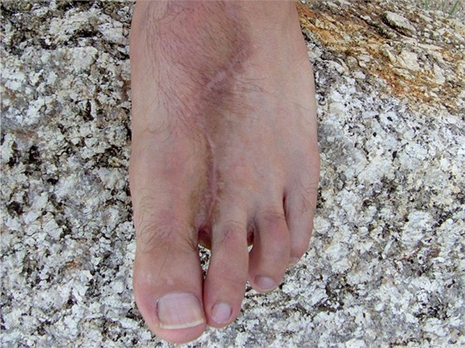 Ảnh chụp bàn chân trái với chỉ có 4 ngón chân của một thợ lặn tên Matt Butcher