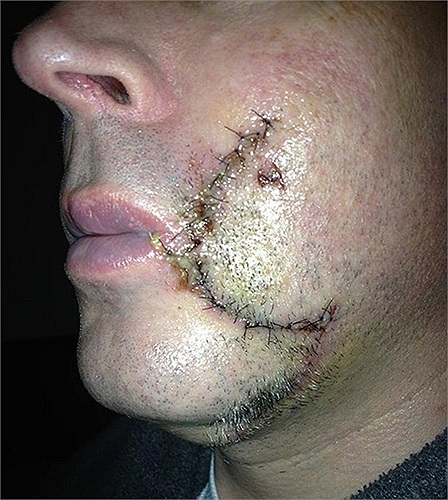 Vào khoảng giữa tháng 7 vừa rồi, Jimmy Griffin, 48 tuổi, cũng bị một con lươn biển tấn công. Nó đớp thẳng vào mặt người thợ lặn này và còn lắc qua lắc lại