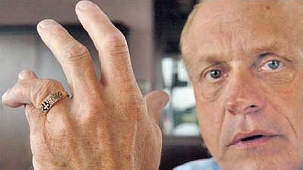 Randy Gradishar, cựu cầu thủ bóng bầu dục, bị tật ngón đeo nhẫn.