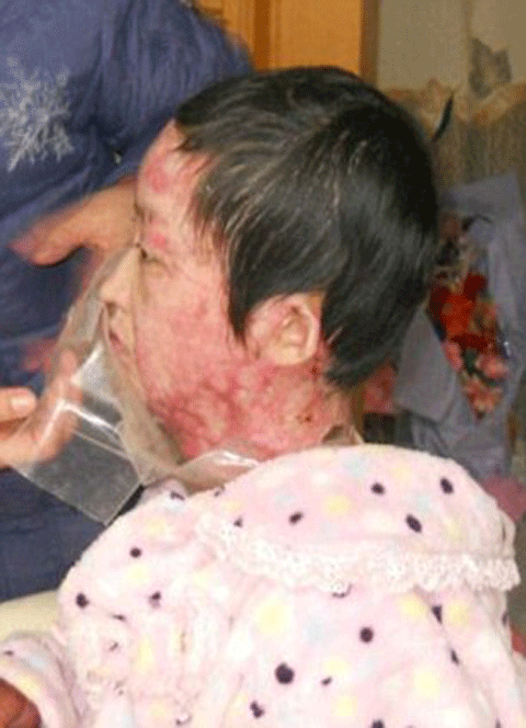 Khuôn mặt thiếu nữ xinh đẹp sau khi bị cháy