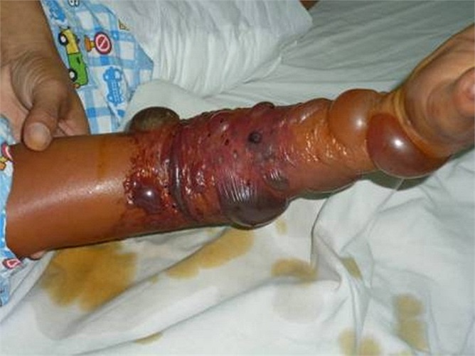 Vào cuối tháng 2 vừa qua, một cháu bé ở Bà Rịa Vũng Tàu bị một con rắn chàm quạp cắn. Mặc dù đã được thầy lang đắp thuốc nhưng cánh tay của bé vẫn sưng phù hoại tử, suýt phải tháo khớp.