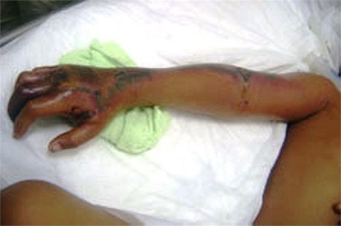 Trung tuần tháng 11, bệnh viện Nhi Đồng 1 tiếp nhận trường hợp của em N.V.T bị rắn hổ mèo cắn dẫn đến hoại tử vì nhiễm độc nặng.