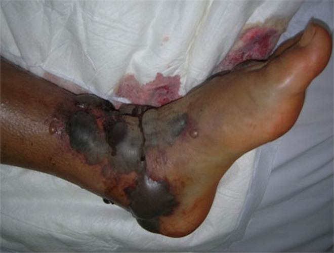 Những vết thương bị hoại tử do rắn độc cắn có thể ảnh hưởng đến sức khoẻ và thậm chí đến tính mạng nạn nhân.