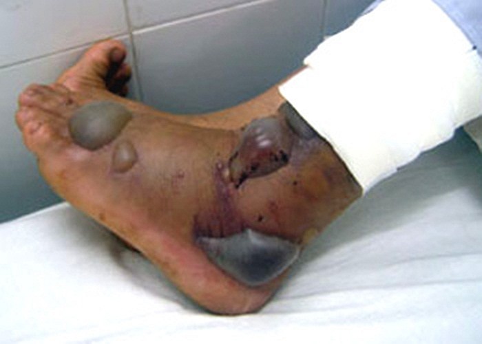 Theo các chuyên gia, khi bị rắn cắn, vết thương cần được xử lý và cấp cứu kịp thời mới có thể tránh được tử vong và sự hoại tử phần cơ thể bị rắn cắn.