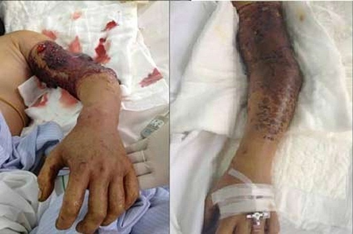 Cần phải dùng một sợi dây thừng hay dây cao su buộc chặt ngay phần phía trên chỗ bị cắn. Lấy dao nhỏ sạch, rạch một hình chữ thập sâu chừng 0,5cm, dài khoảng 0,5-1cm trên vết cắn