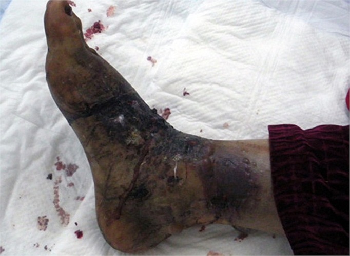 Sau đó bóp hết máu và dịch chảy ra từ chỗ vết cắn, rửa vết cắn bằng nước sạch và nước muối.