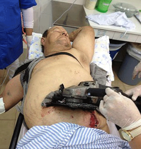 Máy xẻ gỗ đâm thủng bụng