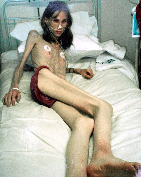 Hậu quả của nhịn đói suốt 20 năm