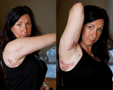 Những vết sẹo lồi đáng sợ khắp người bà Rachel