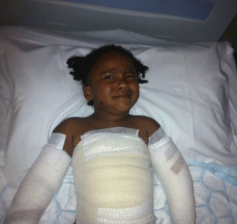 hậu quả nghiêm trọng sau khi bị bỏng