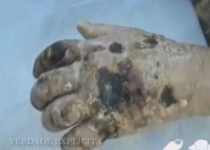 Hình ảnh bàn tay hoại tử của một con nghiện sau khi tiêm chất Krokodil vào người. Tại Nga hiện có khoảng hơn 2,5 triệu người đang mắc phải chứng nghiện ma tuý rẻ tiền này.