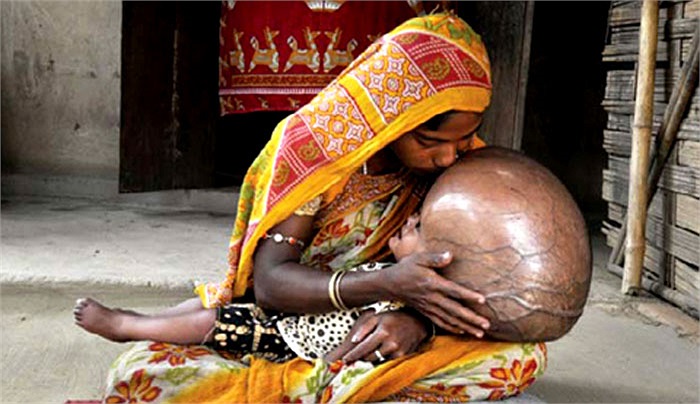 Em bé Roon Begum ở Ấn Độ bị bệnh não úng thủy với chiếc đầu phình to thu hút sự chú ý của toàn thế giới.