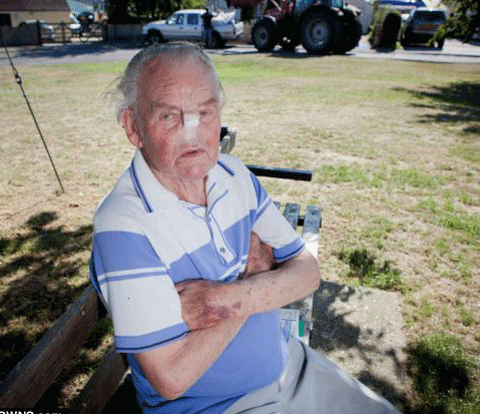 Sau khi bị mất mũi