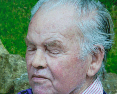 Cyrill sẽ phải mất gần 50 triệu mới có được một chiếc mũi mới