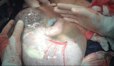 Em bé vẫn nằm trong túi ối còn nguyên vẹn sau khi được đưa ra khỏi bụng mẹ