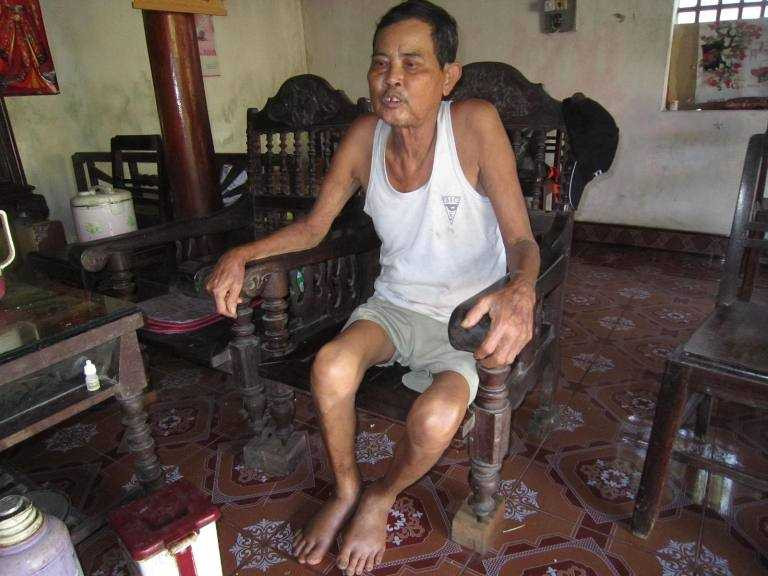 Ông Nguyễn Hữu Lành với bàn chân sưng tấy do viêm da bởi phải thường xuyên lội nước bẩn trong sân, nhà, bếp của gia đình.