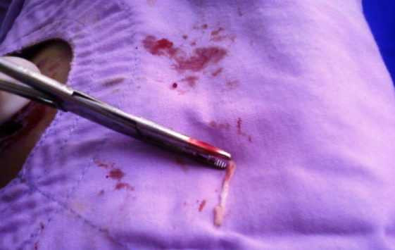Con sán được lấy ra khỏi đùi bệnh nhân 