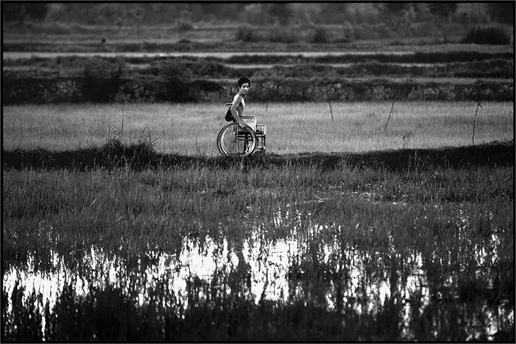 Trong chiến tranh, do điều kiện y tế thiếu thốn nên cắt bỏ chi là một biện pháp được thực hiện phổ biến với những người lính bị thương. Vào thời hậu chiến có rất nhiều người bị mất chi, và sản xuất chân tay giả trở thành một ngành công nghiệp quan t