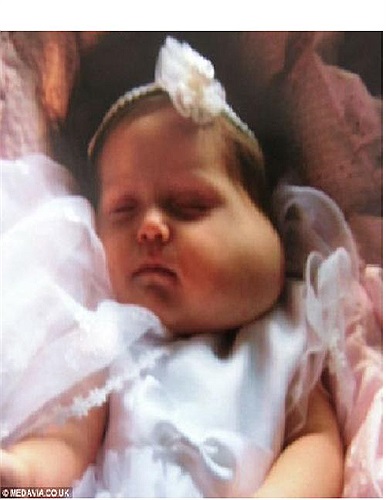 Hình ảnh bé Jessica với cục bướu to bằng quả cam ở má trái. Ảnh chụp lúc bé lên 3 tháng tuổi.