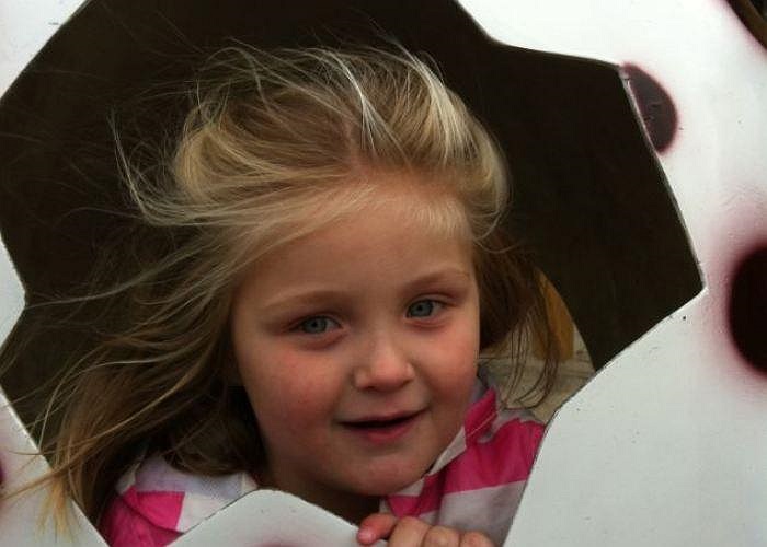 Sau 2 năm điều trị và uống thuốc theo sự chỉ dẫn của bác sĩ, cục bướu trên mặt của Jessica đang có dấu hiệu xẹp đi và tự biến mất.