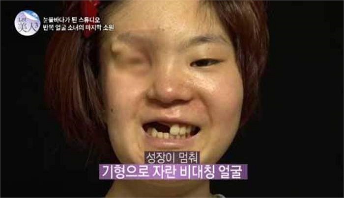 Việc này đã ảnh hưởng tới cấu trúc xương mặt và làn da của cô. Kể từ đó, khuôn mặt Ga Hee bị biến dạng và mất cân xứng, chỉ có bên mặt không hóa trị là phát triển bình thường.