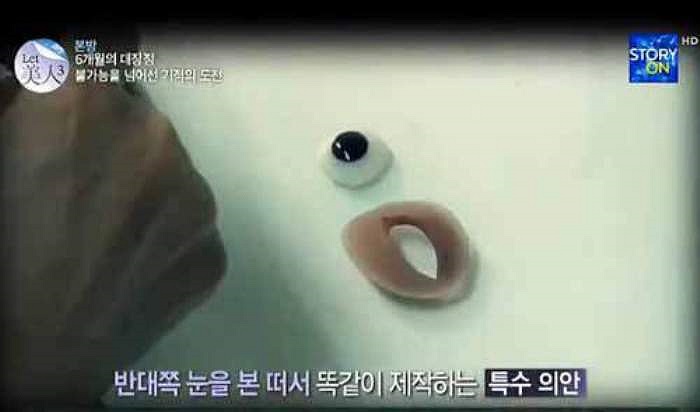 Vì một bên mặt của Ga Hee đã bị biến dạng nên các bác sĩ chỉ còn cách phẫu thuật thêm vào những bộ phận khiếm khuyết. Cô đã được các bác sĩ thực hiện một loạt những ca phẫu thuật bao gồm: gắn mắt giả, trồng răng, gọt cằm và nâng mũi…