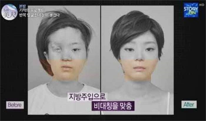 Hình ảnh trực diện khuôn mặt trước và sau khi phẫu thuật thẩm mỹ.