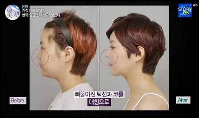 Hình ảnh nhìn nghiêng khuôn mặt trước và sau khi phẫu thuật thẩm mỹ.