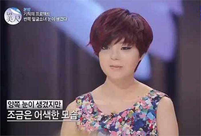 Sau phẫu thuật, Ga Hee tự tin xuất hiện trong chương trình.