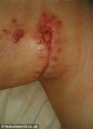 Tai nạn ập đến khi một con cọp lớn nặng hơn 180 ký bất ngờ lao vào tấn công Brennan, chị bị con vật hung dữ này vật xuống đất và đâm móng vuốt vào đùi. Trong ảnh là vết thương của nạn nhân.